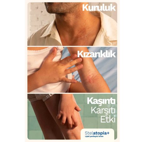 کرم  مرطوب کننده بدن استلاتوپیا 150 گرم موستلا Mustela